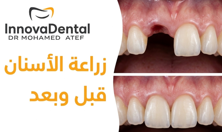 Dental Implants Before and After: Innova Clinics Real Cases